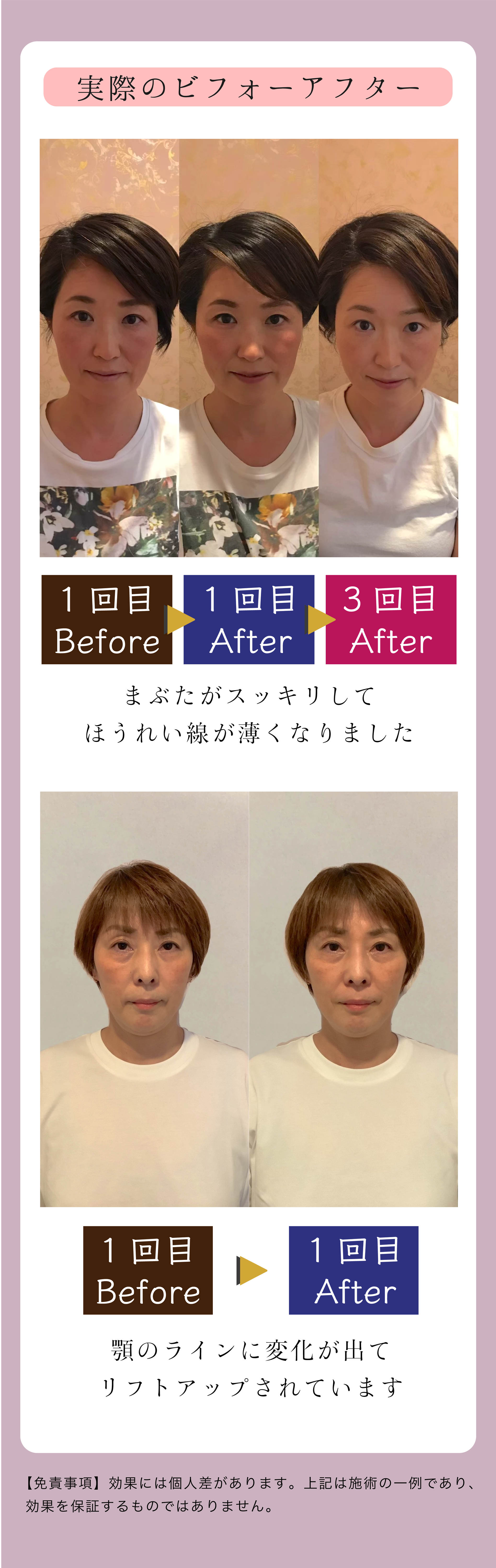 新潟県新潟市の鍼灸サロンmamariの美容鍼ビフォーアフター